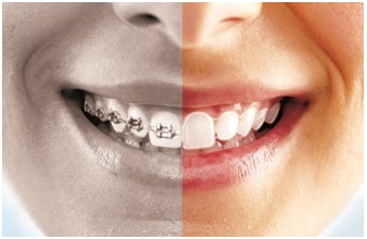 Clear Aligners