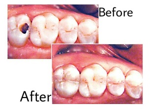 dental filling pune