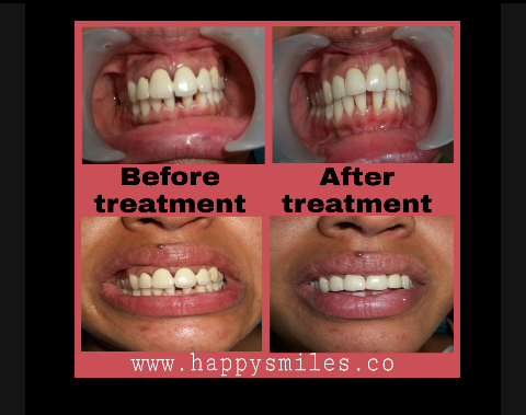smile designing