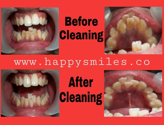 dental cleaning