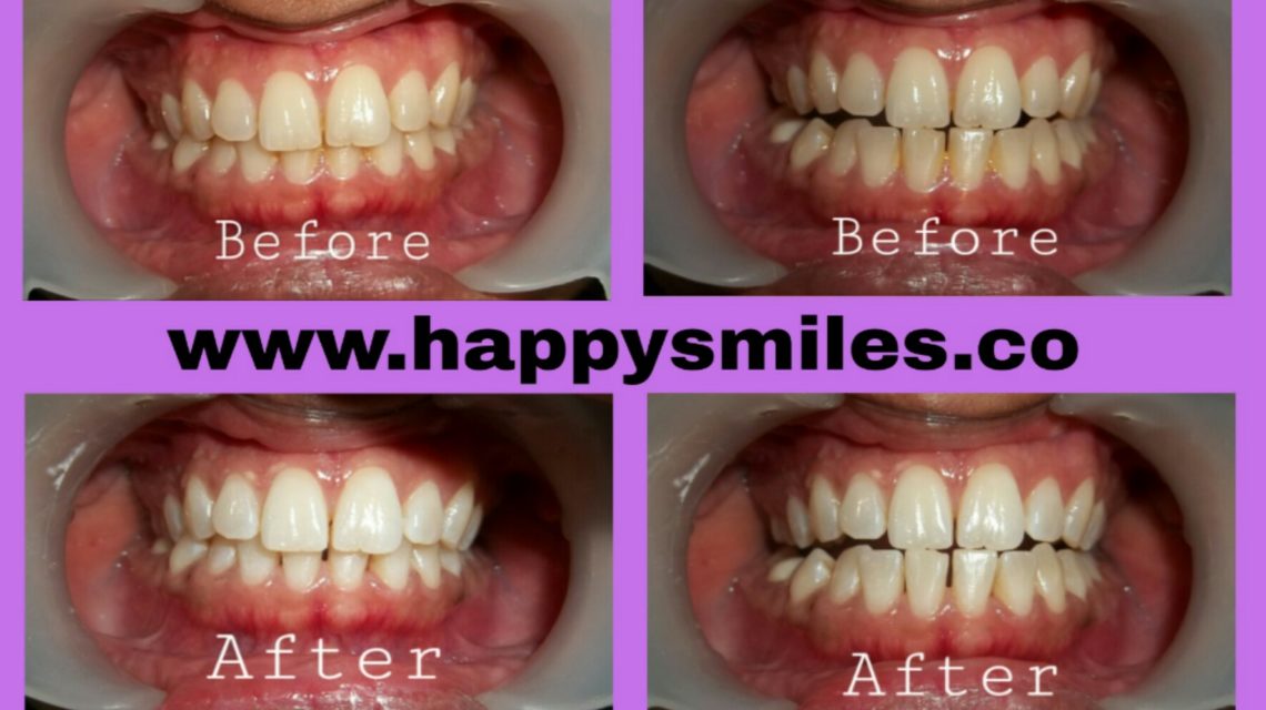 teeth whitening