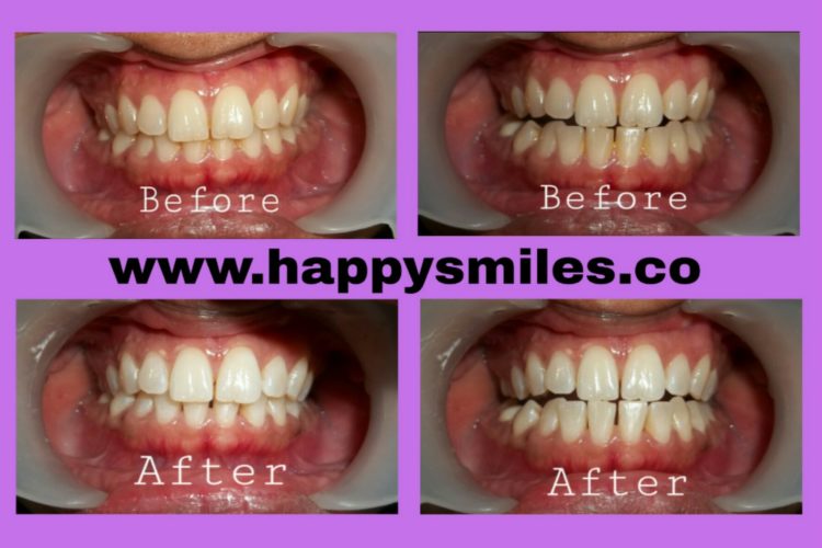 teeth whitening