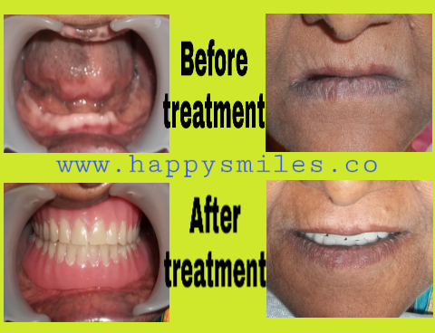 denture