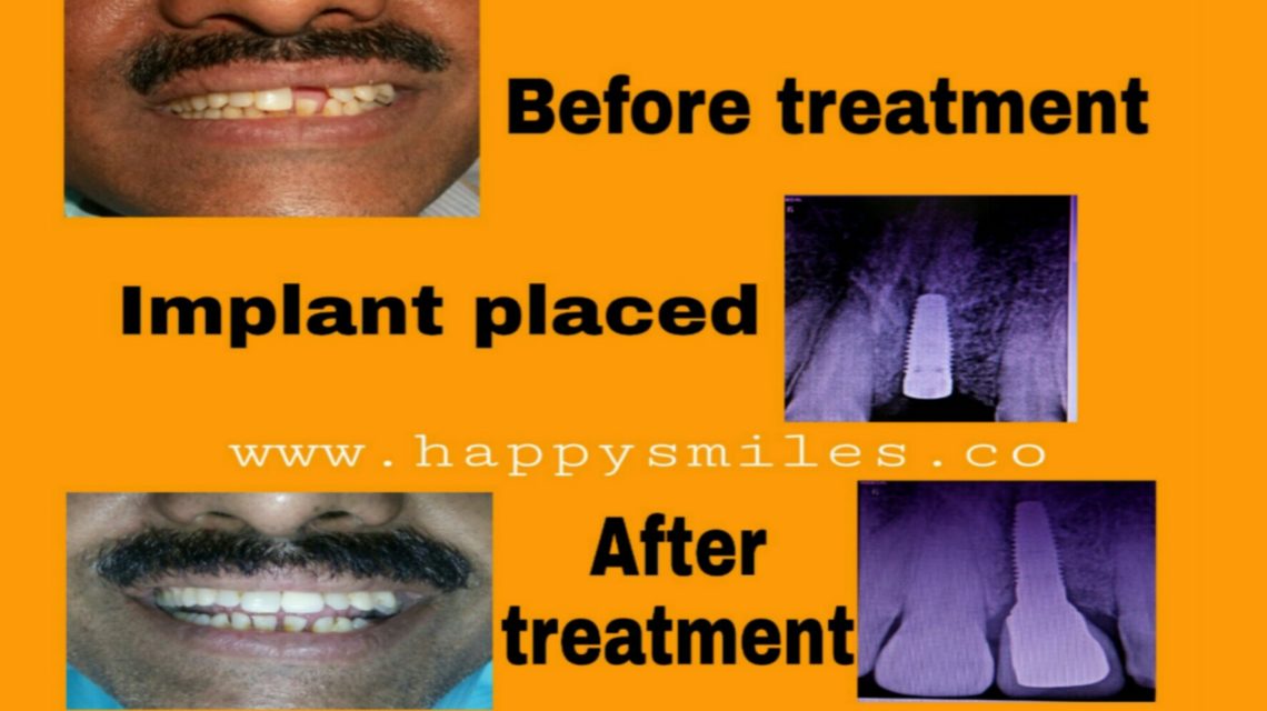dental implant