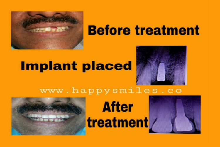 dental implant
