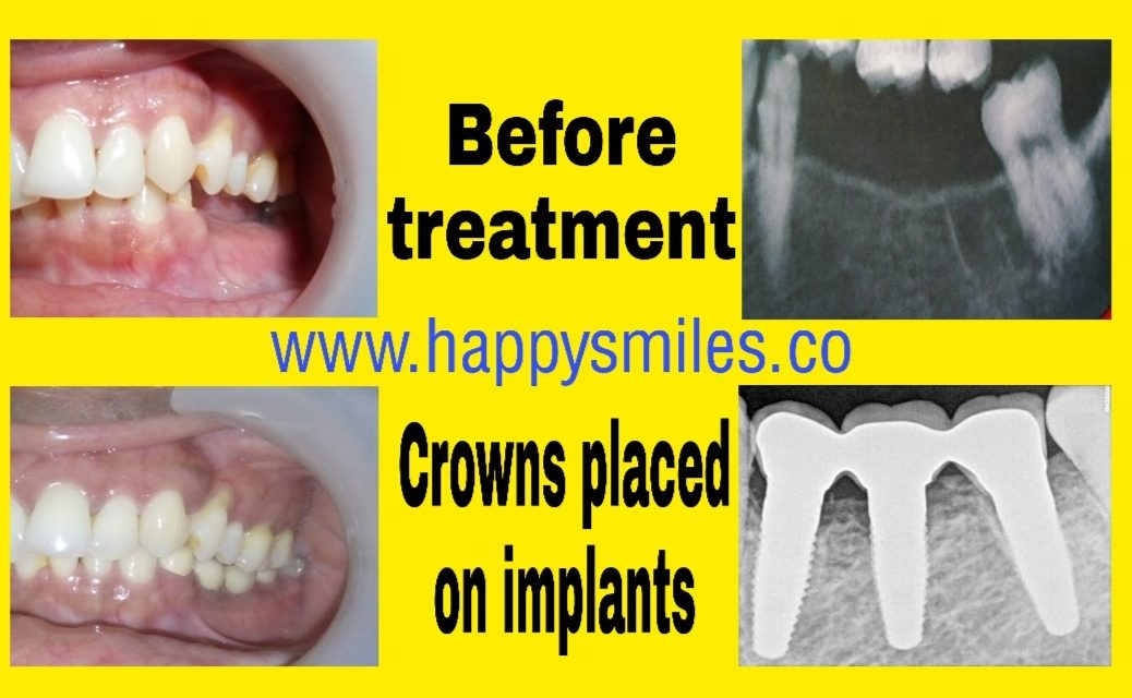 dental implants