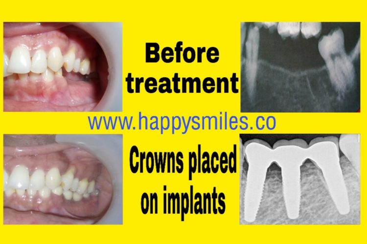 dental implants