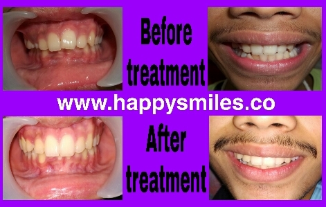 orthodontic treatment