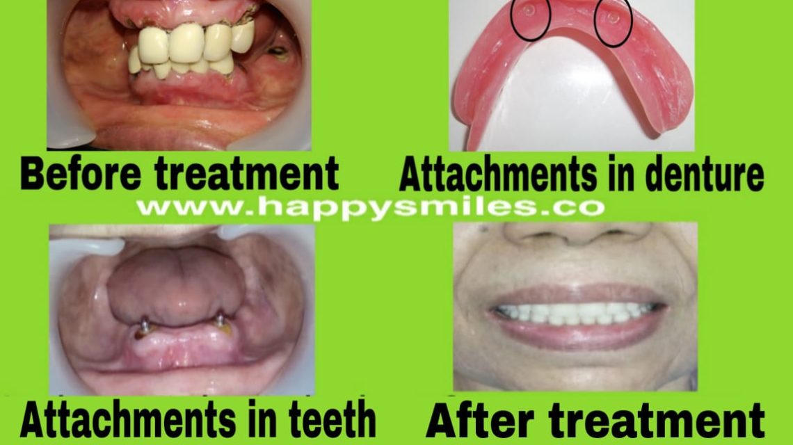 overdenture