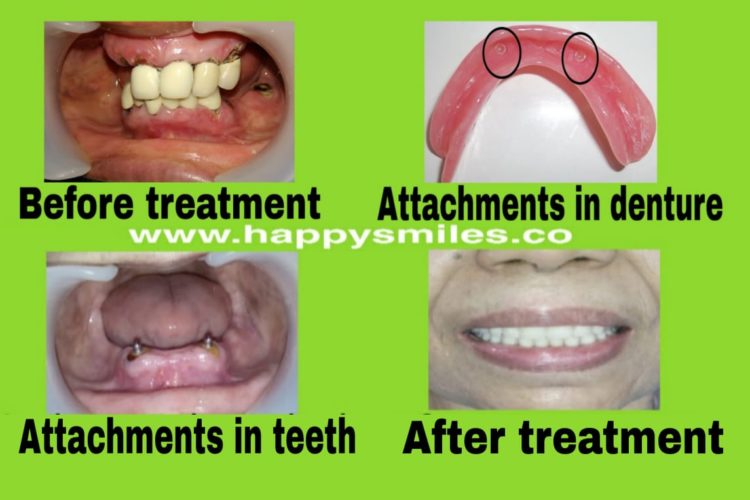 overdenture