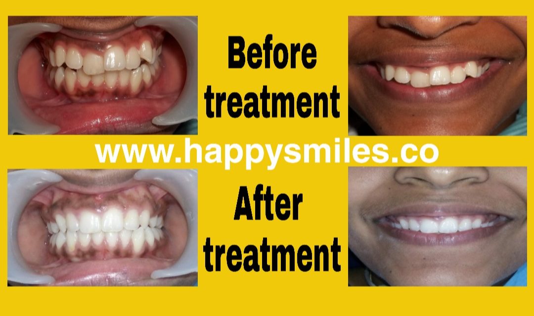 crooked teeth