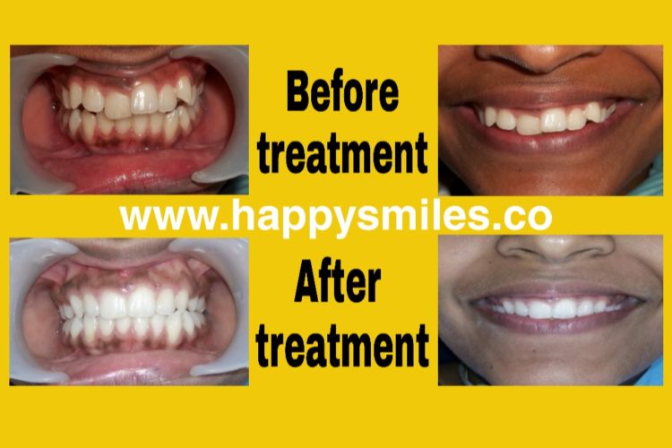 crooked teeth