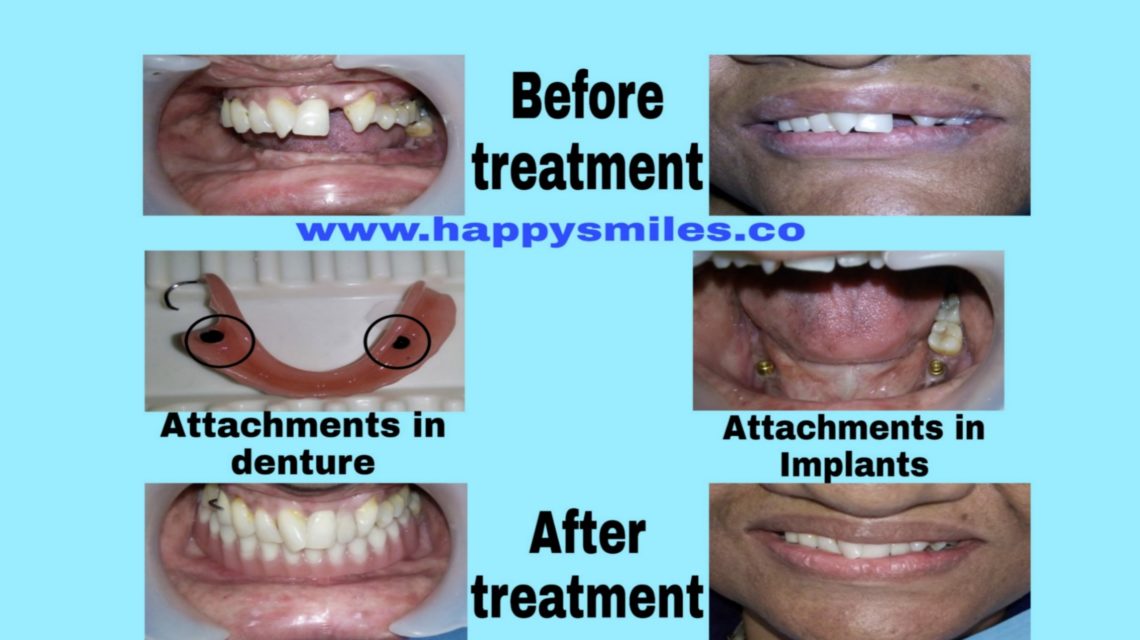 overdenture