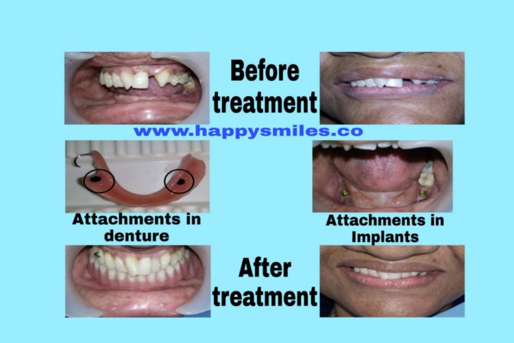 overdenture