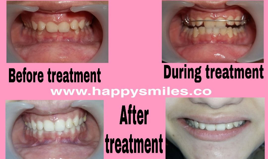 removable orthodontic