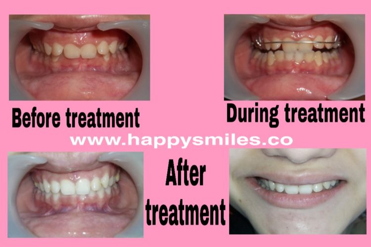 removable orthodontic
