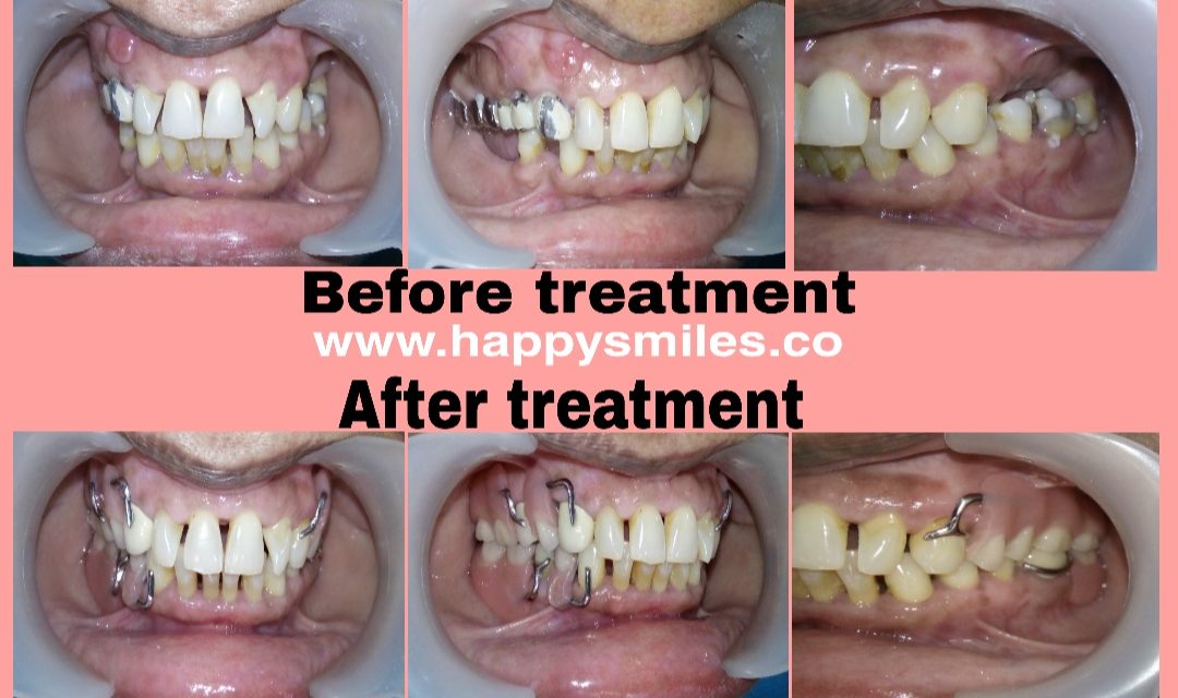 cast partial denture