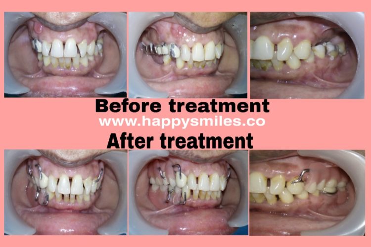 cast partial denture