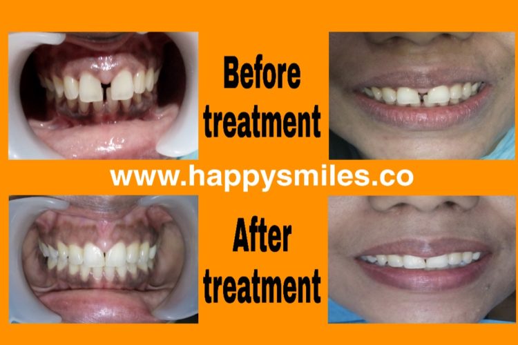 clear aligners