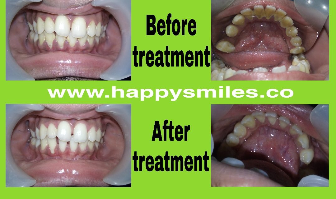 bleeding gums