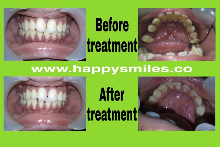 bleeding gums
