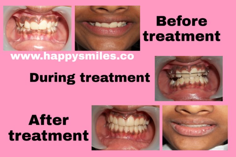 deep overbite
