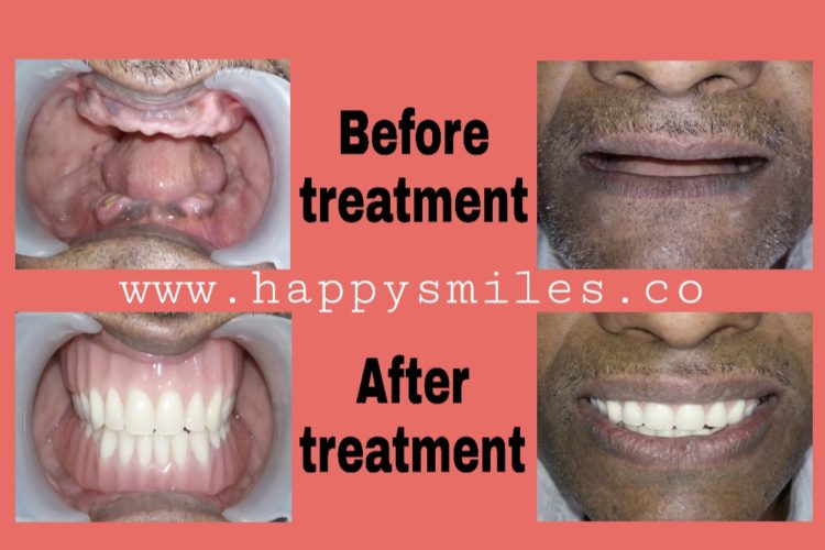 missing teeth
