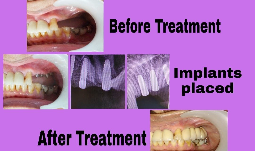 dental implants