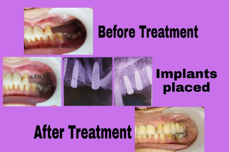 dental implants