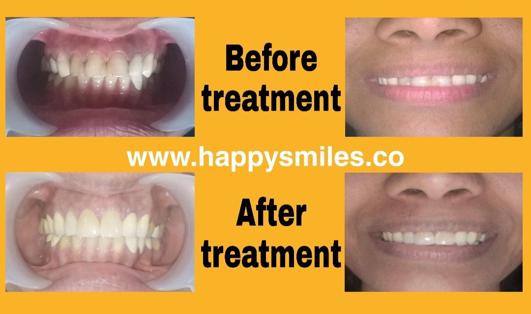 dental veneer