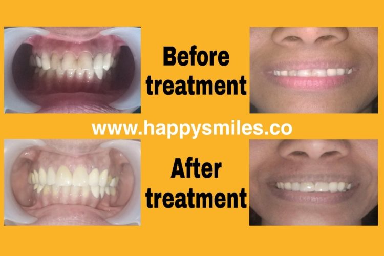 dental veneer