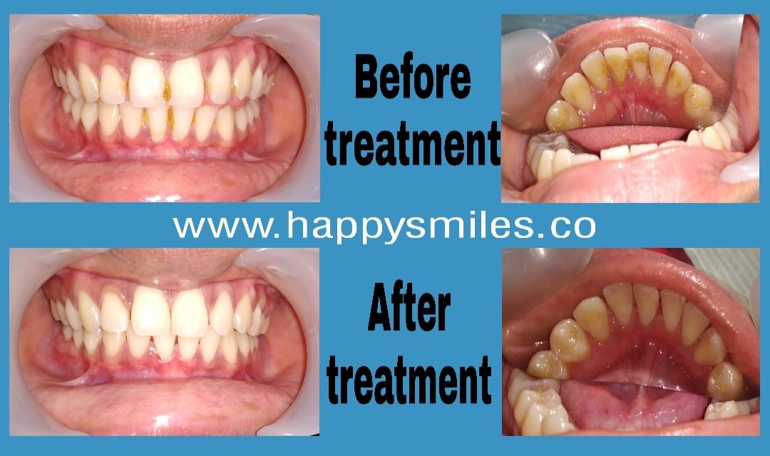 dental cleaning