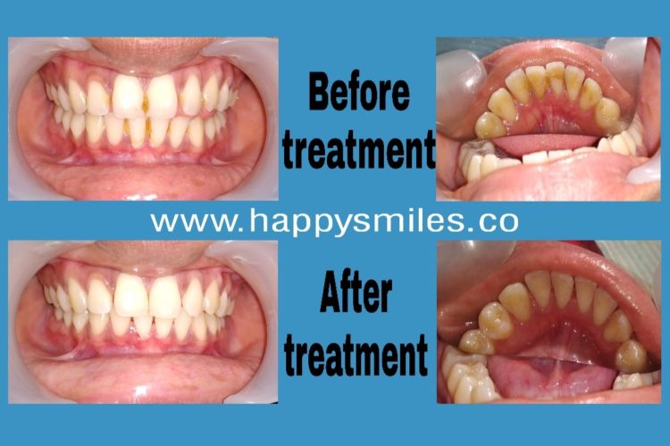 dental cleaning