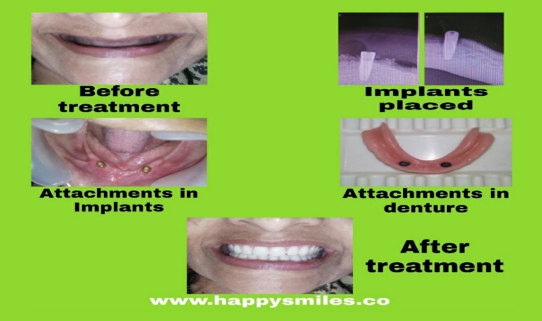 implants
