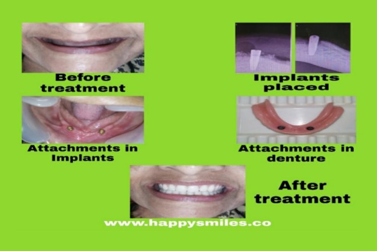 implants
