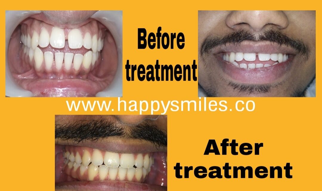 clear aligners