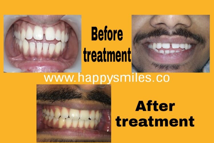 clear aligners