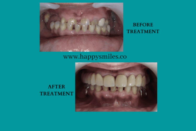 SMILE TEETH REPLACEMENT