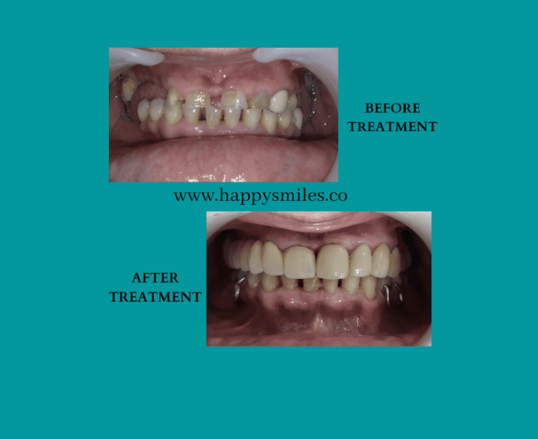 SMILE TEETH REPLACEMENT